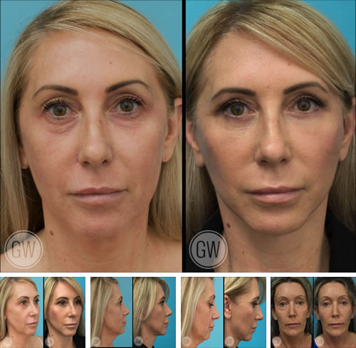 Facelift or Face lift Procedure page main image