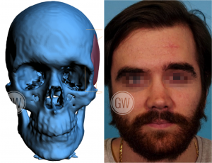 Facial Reconstruction After Surgery Procedure Image - General Reconstruction