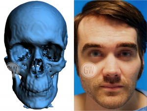 Facial Reconstruction Before Surgery Procedure Image - General Reconstruction