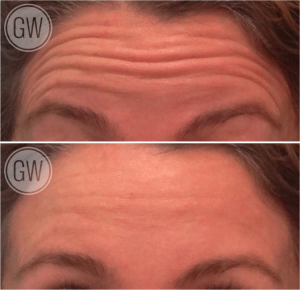 Wrinkle Relaxers - Dr Guy Watts