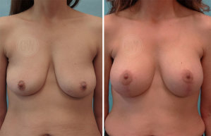  breast lift featured image - Dr Guy Watts Surgeon perth 