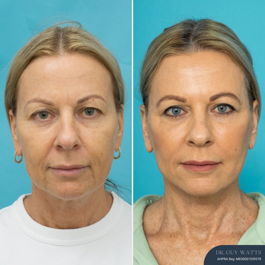 3 Mths Post-op Face Lift + Posterior Neck Lift + Bilateral Upper + Bilateral Lower Blepharoplasty + Facial Fat Grafting + TCA Chemical Peel - F