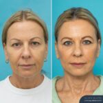 3 Mths Post-op Face Lift + Posterior Neck Lift + Bilateral Upper + Bilateral Lower Blepharoplasty + Facial Fat Grafting + TCA Chemical Peel - F