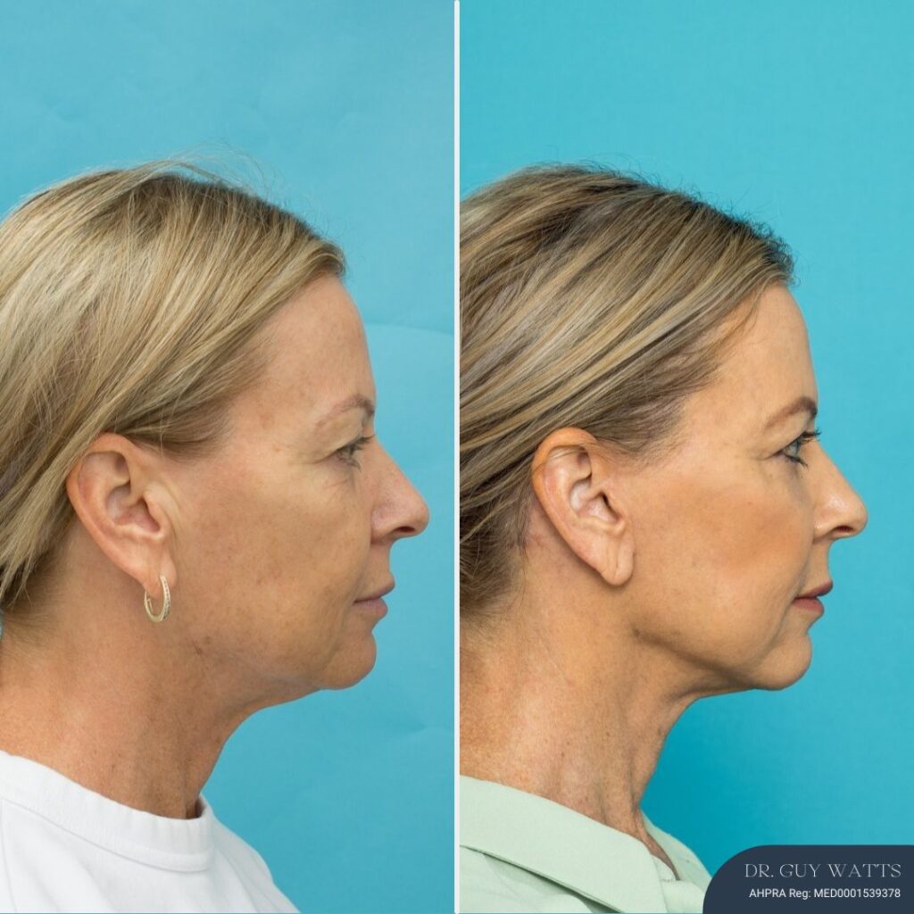 3 Mths Post-op Face Lift + Posterior Neck Lift + Bilateral Upper + Bilateral Lower Blepharoplasty + Facial Fat Grafting + TCA Chemical Peel - R90