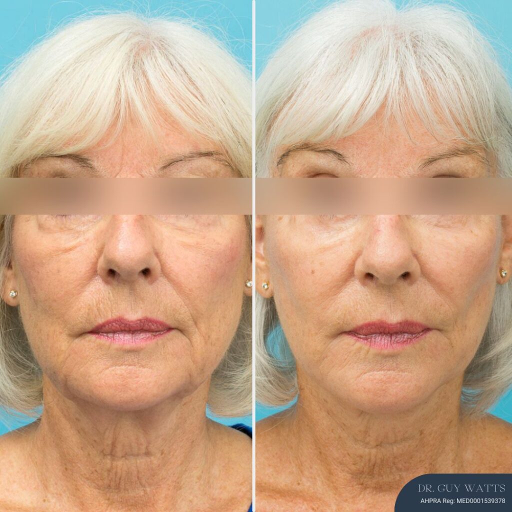 12 Months Post-op Face and Neck Lift - NO EYES