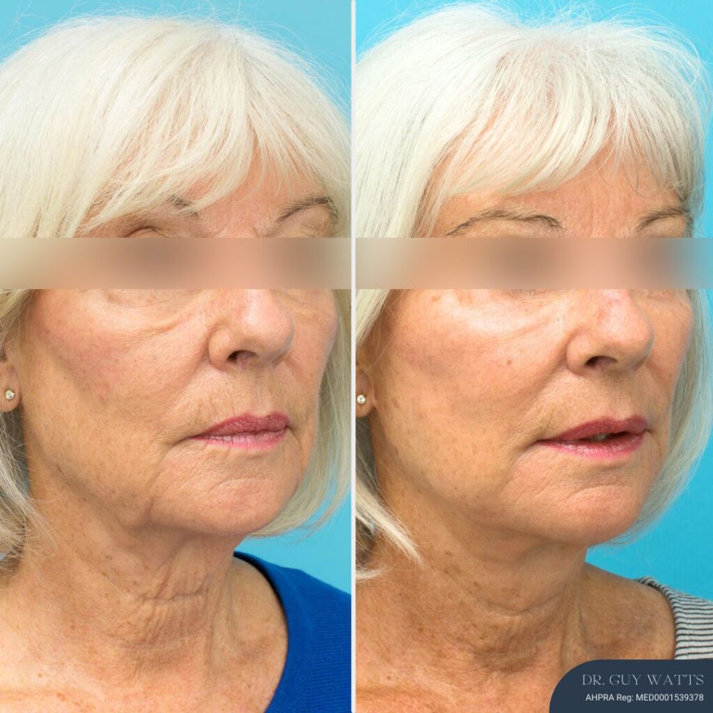 12 Months Post-op Face and Neck Lift - NO EYES