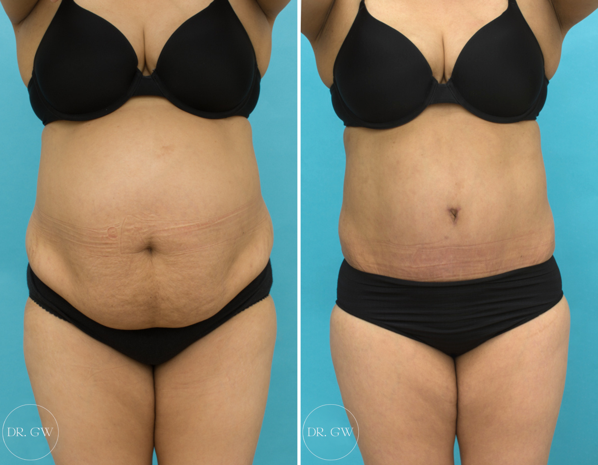 Abdominoplasty + 360 Liposuction Surgery by Dr Guy Watts Front