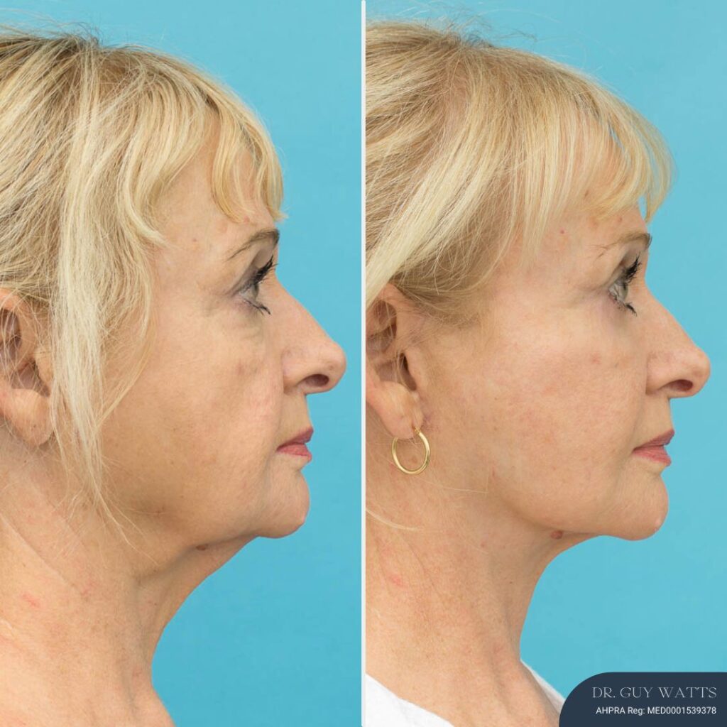 4 Months Post Face and posterior necklift + Temporal browlift + bilateral canthoplasty + fat grafting + TCA peel