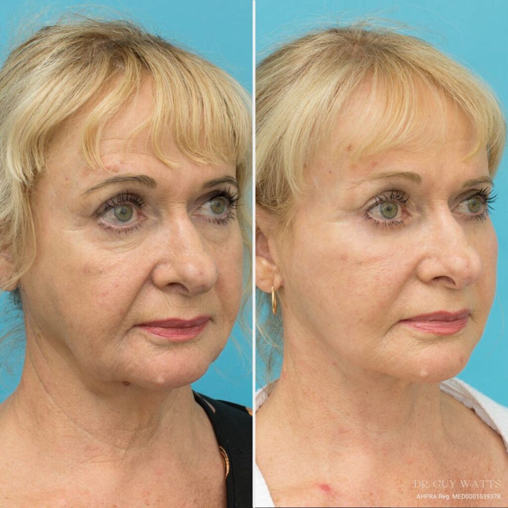 4 Months Post Face and posterior necklift + Temporal browlift + bilateral canthoplasty + fat grafting + TCA peel