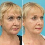 4 Months Post Face and posterior necklift + Temporal browlift + bilateral canthoplasty + fat grafting + TCA peel