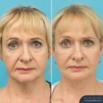 4 Months Post Face and posterior necklift + Temporal browlift + bilateral canthoplasty + fat grafting + TCA peel
