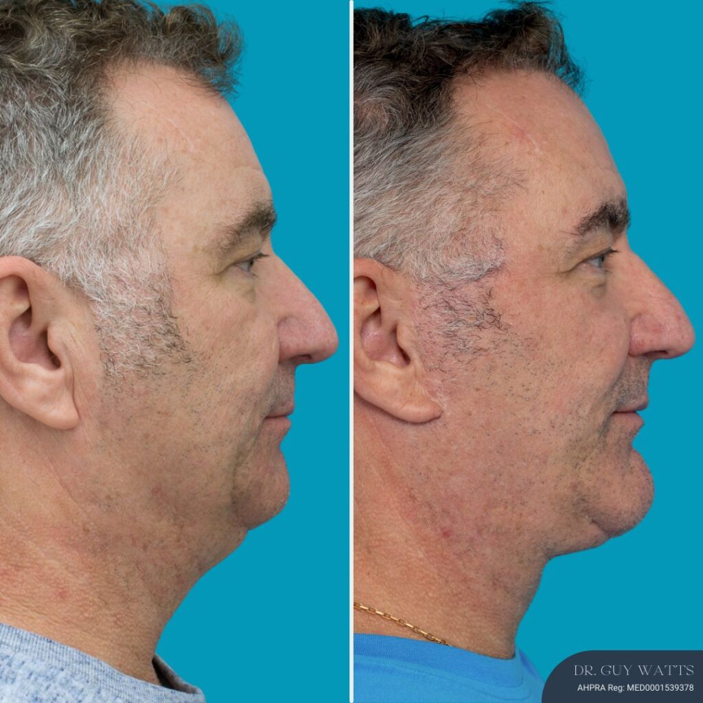 12 Months Post-op Face Lift + Anterior Neck Lift + Genioplasty