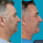 12 Months Post-op Face Lift + Anterior Neck Lift + Genioplasty