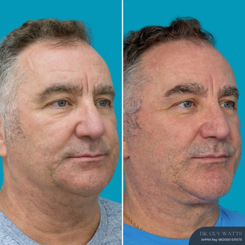 12 Months Post-op Face Lift + Anterior Neck Lift + Genioplasty