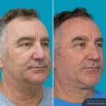 12 Months Post-op Face Lift + Anterior Neck Lift + Genioplasty