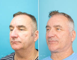 Rhinoplasty + Septoplasty + Bilateral Turbinate Reduction