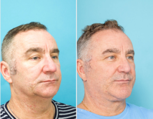 Rhinoplasty + Septoplasty + Bilateral Turbinate Reduction