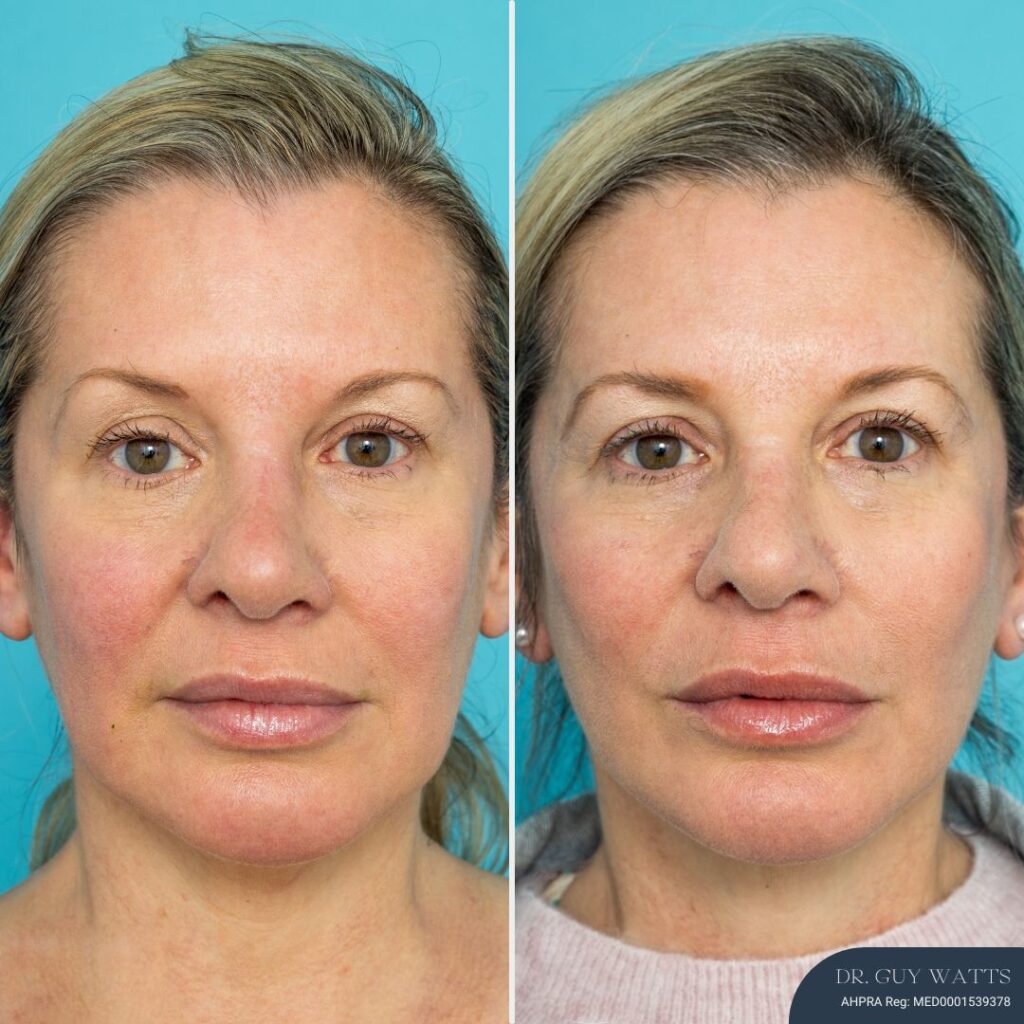 12 Months Post Face Lift