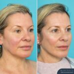 Post Face Lift