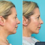 Post Face Lift