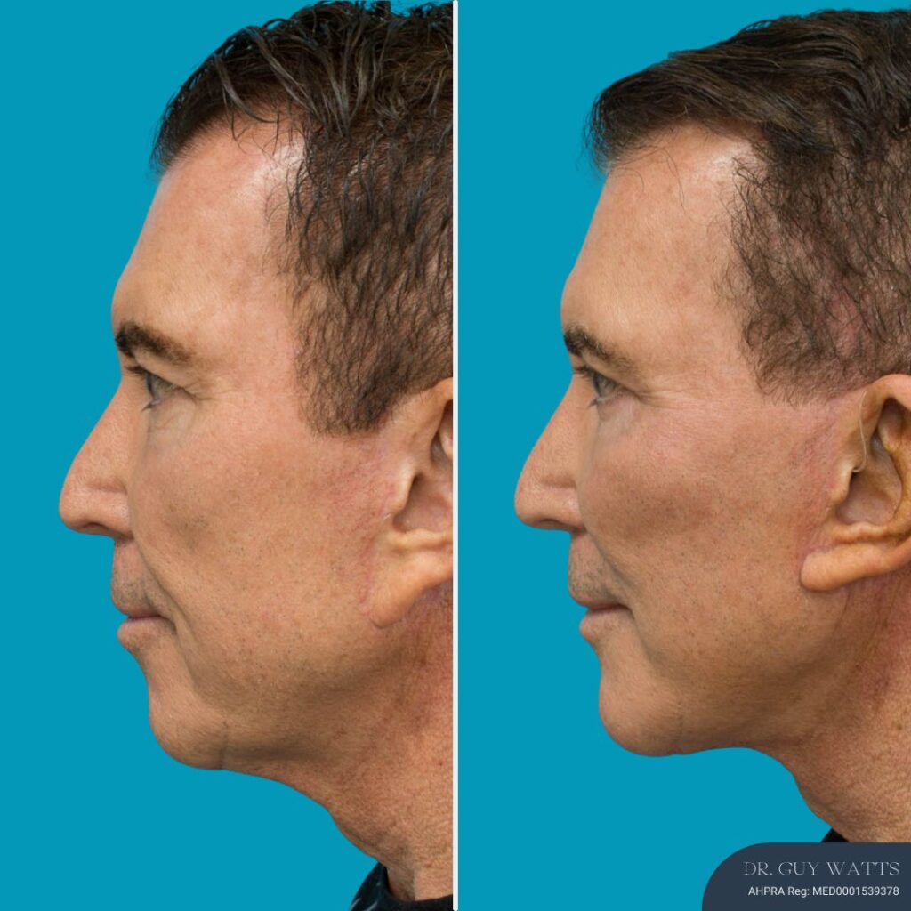 3 Months Post-op Face and Neck Lift + Temporal Lift + Genioplasty + Upper and Lower Blepharoplasty