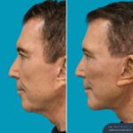 3 Months Post-op Face and Neck Lift + Temporal Lift + Genioplasty + Upper and Lower Blepharoplasty