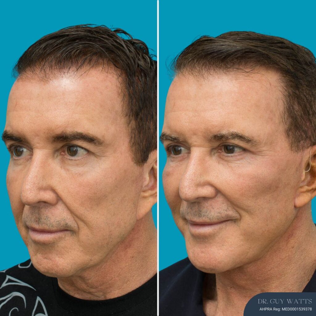 3 Months Post-op Face and Neck Lift + Temporal Lift + Genioplasty + Upper and Lower Blepharoplasty