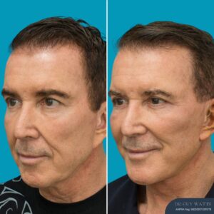 3 Months Post-op Face and Neck Lift + Temporal Lift + Genioplasty + Upper and Lower Blepharoplasty