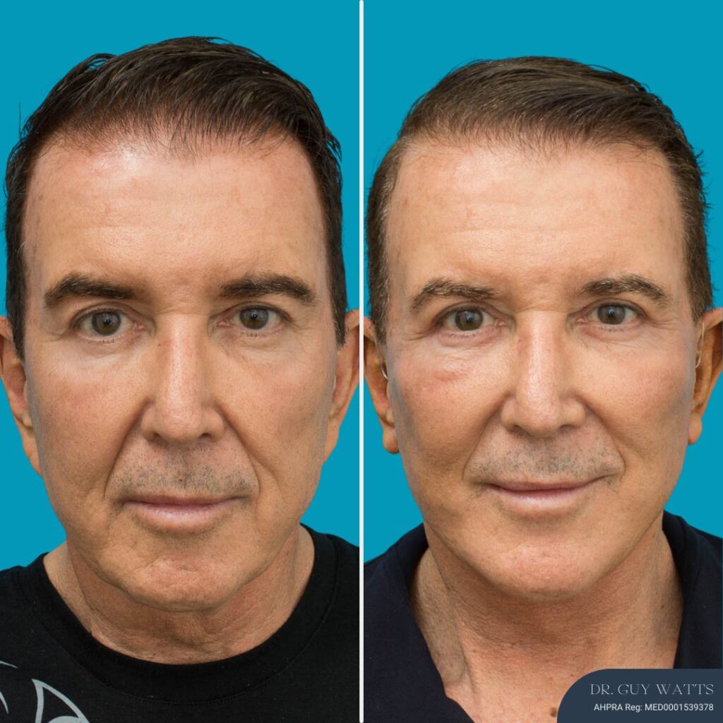 3 Months Post-op Face and Neck Lift + Temporal Lift + Genioplasty + Upper and Lower Blepharoplasty