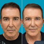 3 Months Post-op Face and Neck Lift + Temporal Lift + Genioplasty + Upper and Lower Blepharoplasty