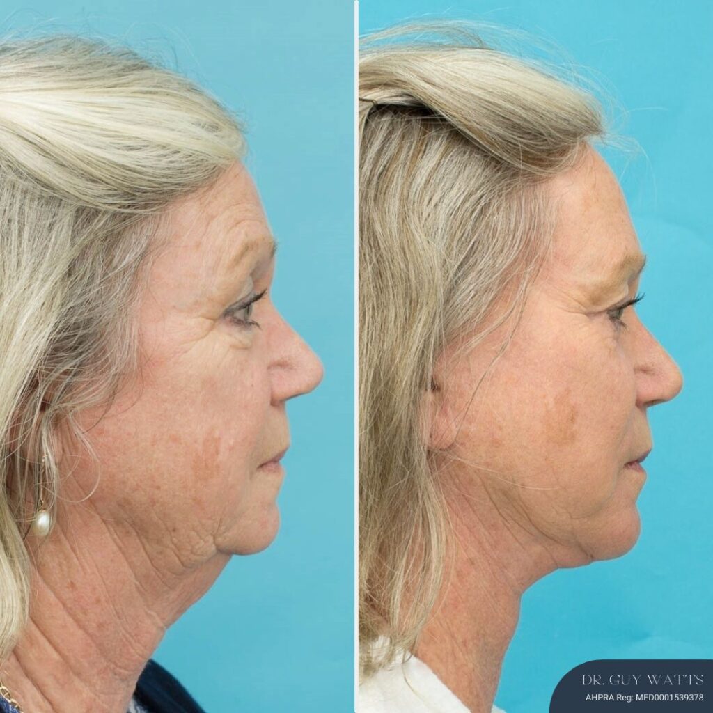 12 months post-op⁠ - Face & Neck Lift + Bilateral Upper & Lower Blepharoplasty + Facial Fat Grafting + TCA Peel