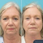12 months post-op⁠ - Face & Neck Lift + Bilateral Upper & Lower Blepharoplasty + Facial Fat Grafting + TCA Peel (2)