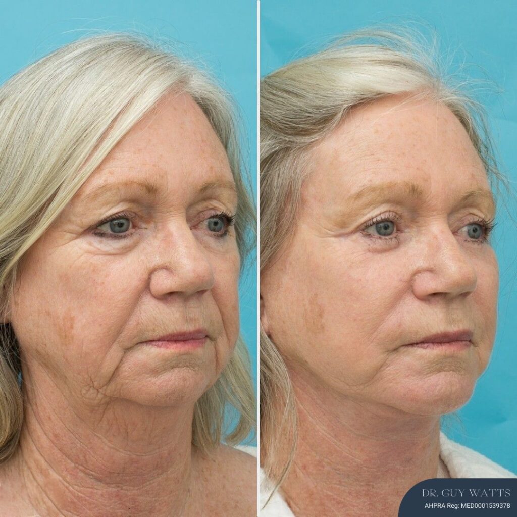 12 months post-op⁠ - Face & Neck Lift + Bilateral Upper & Lower Blepharoplasty + Facial Fat Grafting + TCA Peel
