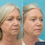 12 months post-op⁠ - Face & Neck Lift + Bilateral Upper & Lower Blepharoplasty + Facial Fat Grafting + TCA Peel
