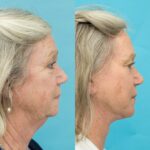 Face & Neck Lift + Bilateral Upper & Lower Blepharoplasty + Facial Fat Grafting + TCA Peel - 12 months post-op