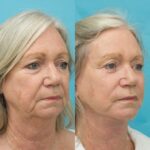 Face & Neck Lift + Bilateral Upper & Lower Blepharoplasty + Facial Fat Grafting + TCA Peel - 12 months post-op.