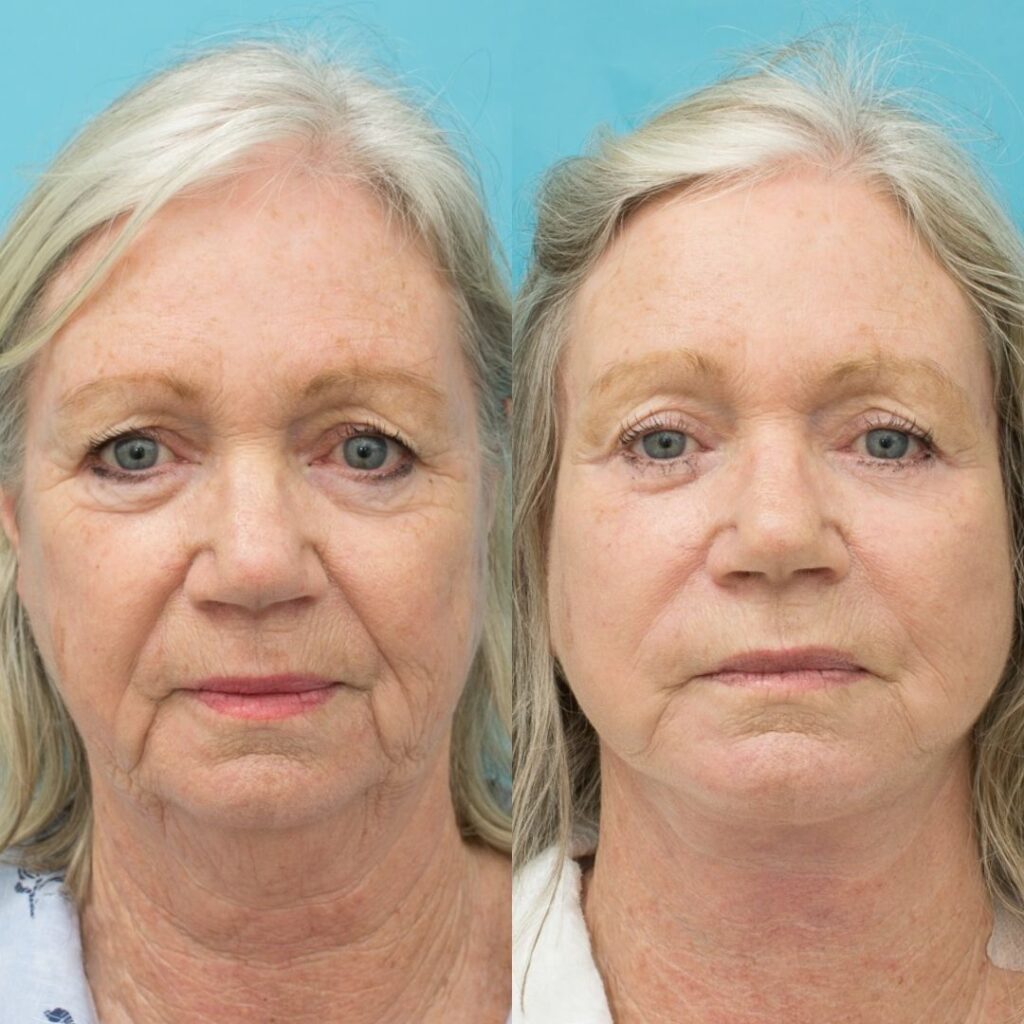 Face & Neck Lift + Bilateral Upper & Lower Blepharoplasty + Facial Fat Grafting + TCA Peel - 12 months post-op⁠
