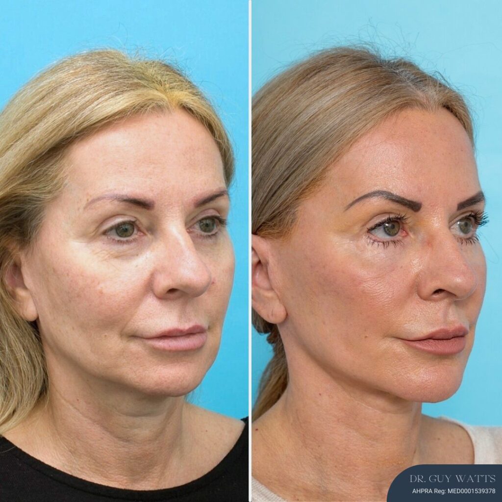 12 months post-op⁠ Face and Neck Lift + Bilateral Lower Blepharoplasty + Facial Fat Grafting
