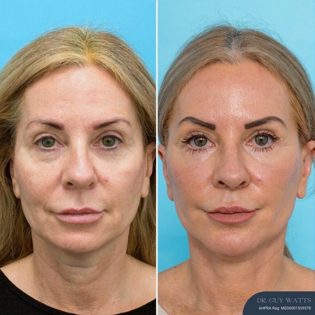 12 months post-op⁠ Face and Neck Lift + Bilateral Lower Blepharoplasty + Facial Fat Grafting