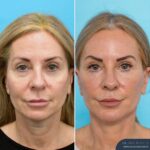 12 months post-op⁠ Face and Neck Lift + Bilateral Lower Blepharoplasty + Facial Fat Grafting