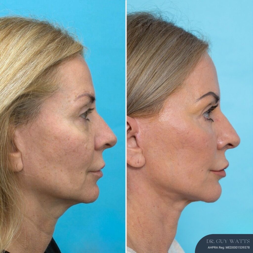 12 months post-op⁠ Face and Neck Lift + Bilateral Lower Blepharoplasty + Facial Fat Grafting