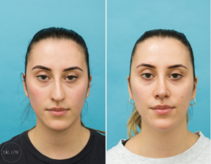 Rhinoplasty + Septoplasty + Bilateral Turbinate Reduction