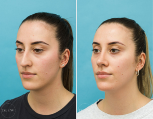 Rhinoplasty + Septoplasty + Bilateral Turbinate Reduction