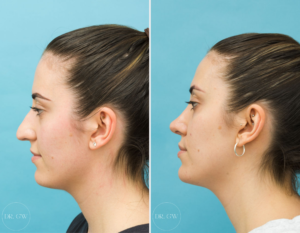 Rhinoplasty + Septoplasty + Bilateral Turbinate Reduction