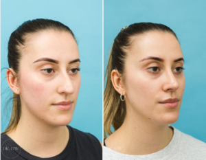 Rhinoplasty + Septoplasty + Bilateral Turbinate Reduction