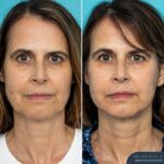 3 Months Post-op Face and Posterior Neck Lift