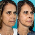 3 Months Post-op Face and Posterior Neck Lift