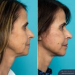 3 Months Post-op Face and Posterior Neck Lift