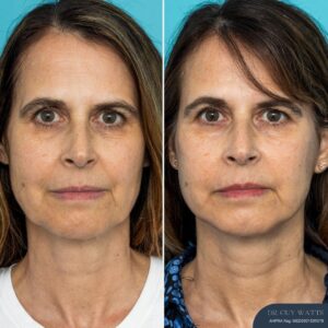 3 Months Post-op Face and Posterior Neck Lift
