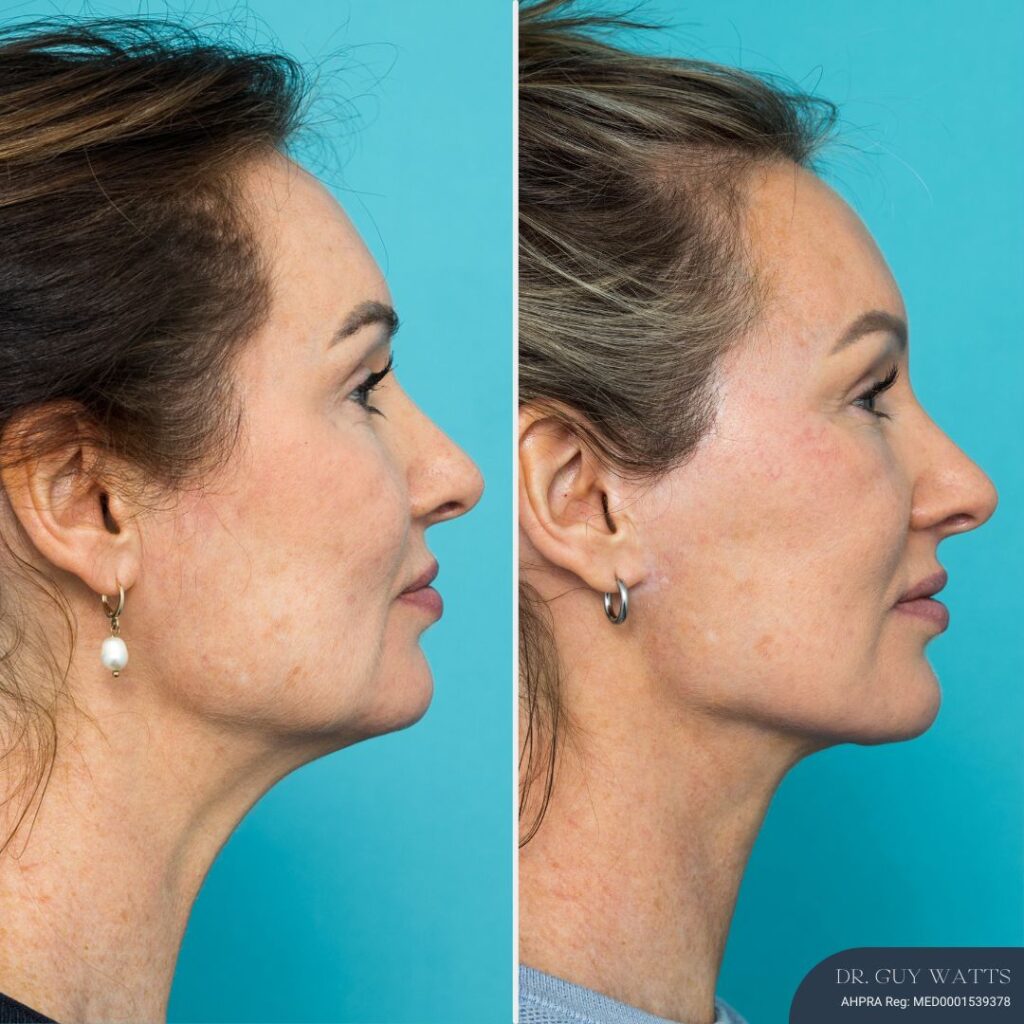 12mths Post-op Face and Neck Lift